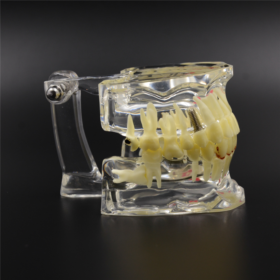 Dental Study Tooth Transparent Adult Pathological & Disease Teeth Model