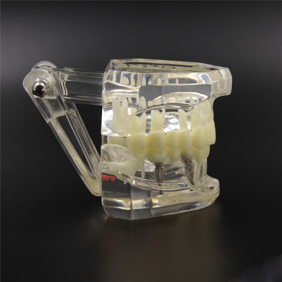 NEW Dental Implant Study Analysis Demonstration Teeth Model with Restoration