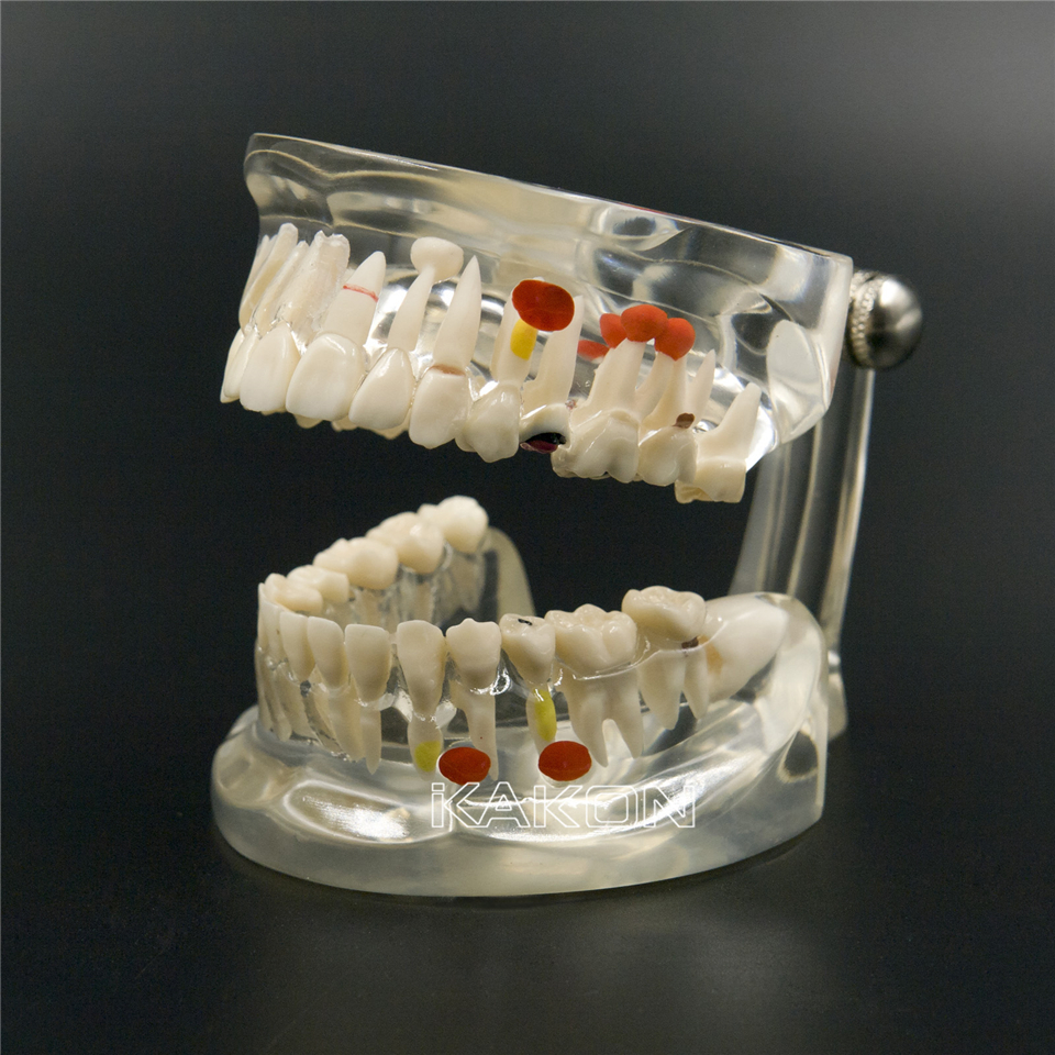 New Dental Study Teaching Model Disease Model Removable Teeth