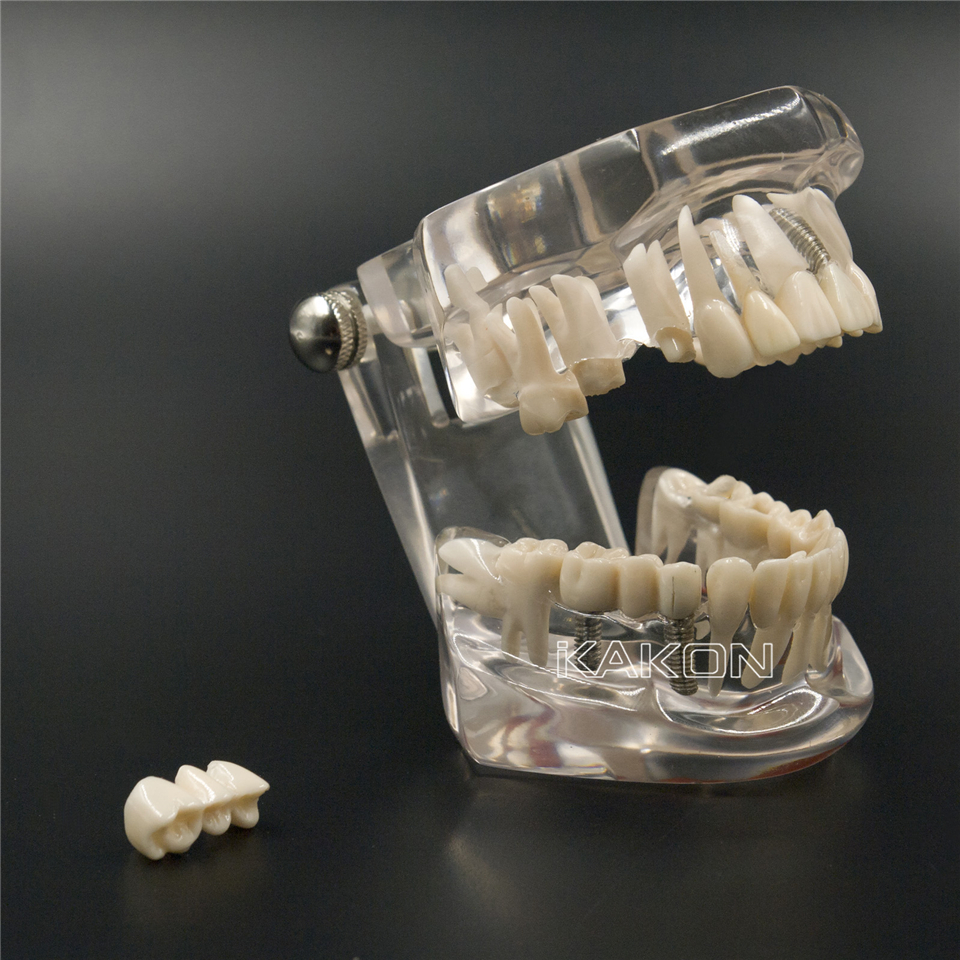 NEW Dental Implant Study Analysis Demonstration Teeth Model with Restoration 