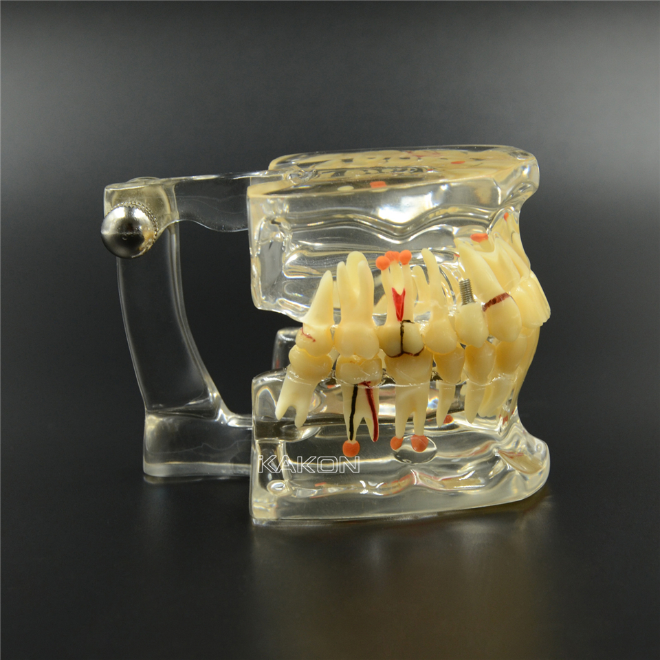 Dental Study Tooth Transparent Adult Pathological & Disease Teeth Model