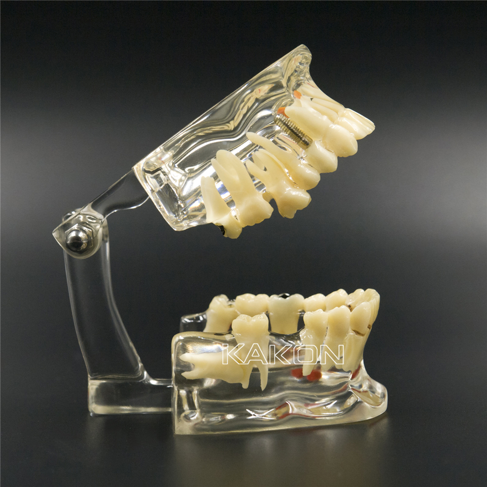 1 X  Dental Implant Disease Tooth Pathological Extrusion Missing Teeth Model