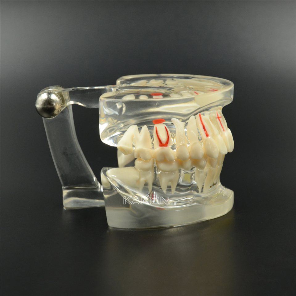 Dental Teeth Study Model Classic Implant Typodont Model Restoration removable