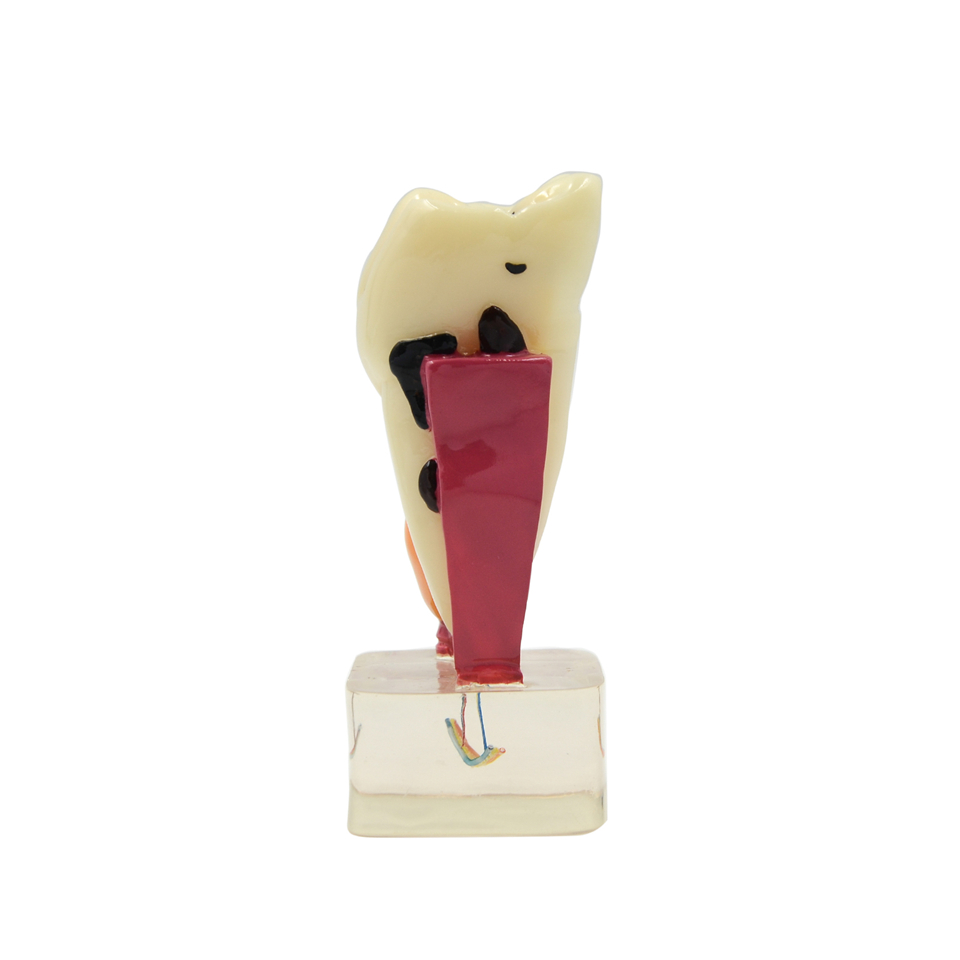 4:1 Dentist Dental Study Teach Tooth Model Teeth Disease Model Free Ship