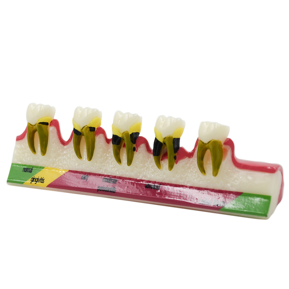 Dental Periodontal Disease assort Teeth Dentoform Typodont Study Teaching Model