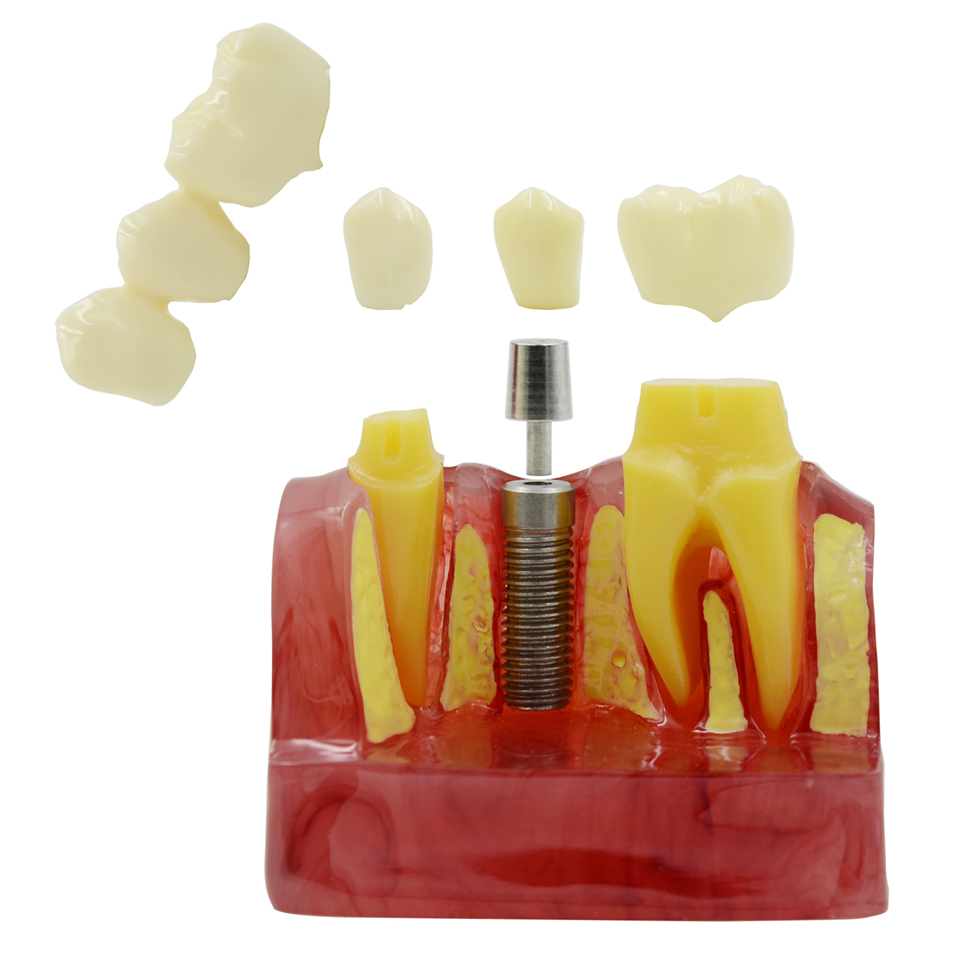 MACRO IMPLANT MODEL CROWN BRIDGE DEMOSTRATATION TEETH TOOH TYPODONT DENTOFORM
