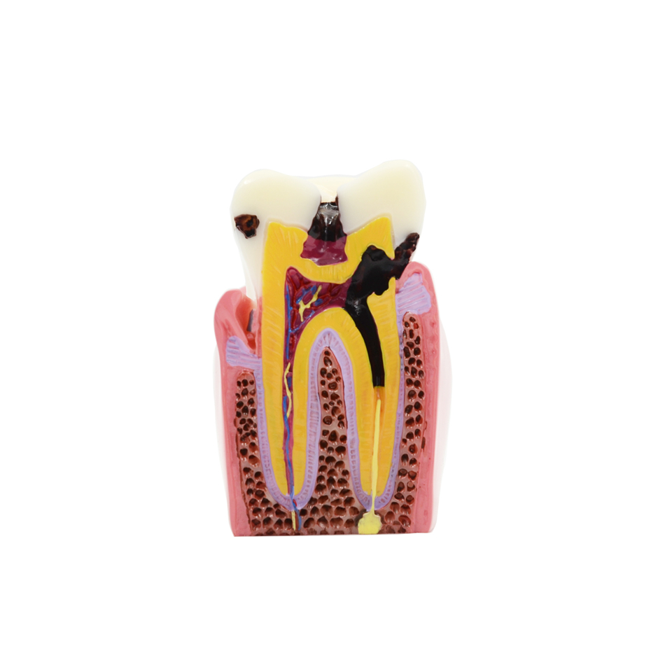 Oral Model 4 Times Dental Caries Comparison Model Dental Tooth Model